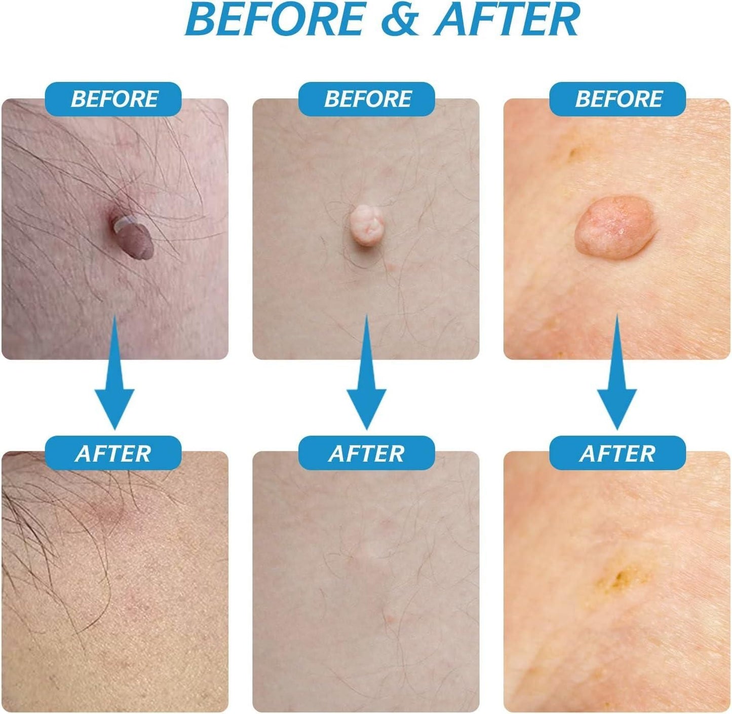 2 in 1 SKIN TAG REMOVER KIT - ABSOLUTELY PAINLESS