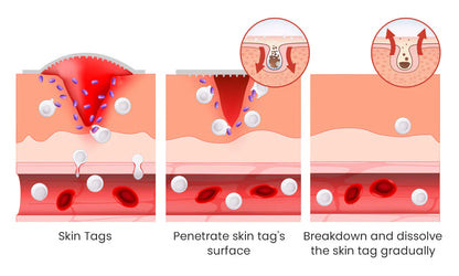 2 in 1 SKIN TAG REMOVER KIT - ABSOLUTELY PAINLESS